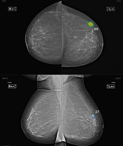 ROE Mammographie